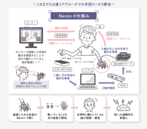 手指の麻痺を改善するリハビリテーション支援ロボットイラスト