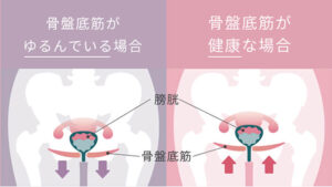 骨盤底筋専用EMS「SIXPAD Perine Fit(シックスパッド ペリネフィット)」