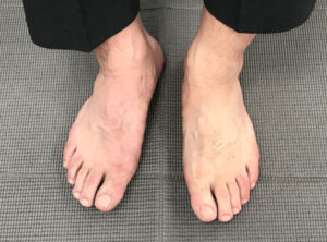 【出典】ONE DE MAYU（写真ではわかりにくいですが、左足が施術後の明るい足の色。右側が薄紫色の状態）