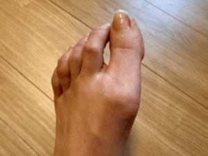 【出典】ONE DE MAYU（浮指と外反母趾の状態になっている足は、骨盤周りの滞りのサイン）